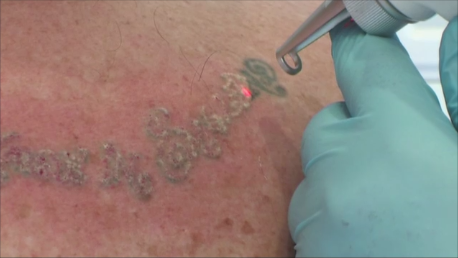 tattoo removal