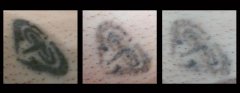 laser tattoo removal treatment example