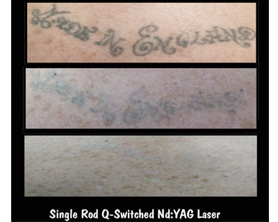 Examples of Laser Tattoo Removal